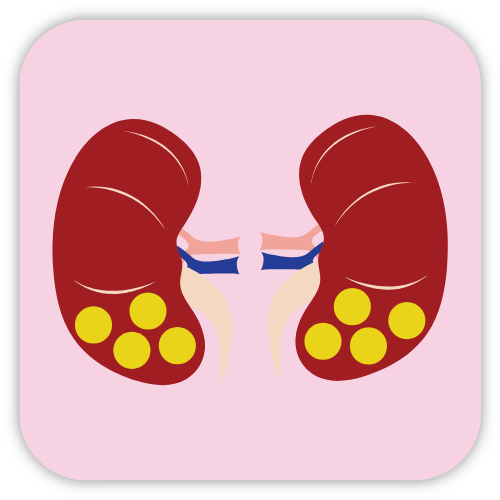 Kidney Stones