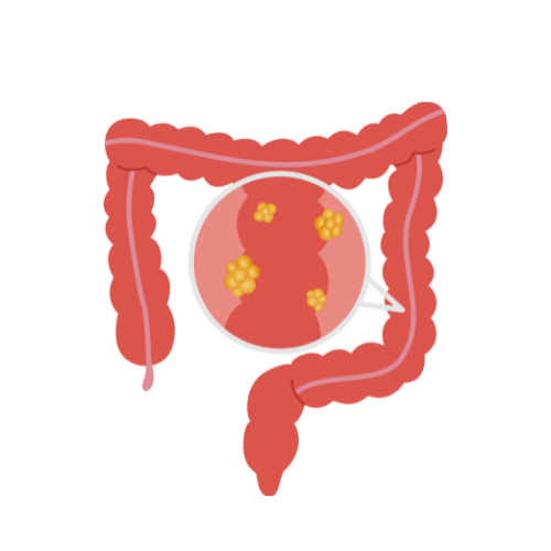 Colorectal Cancer